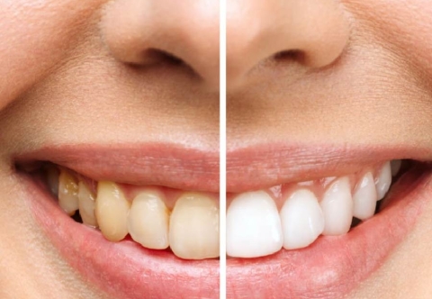 Tẩy trắng răng có đau không? Có bị vàng lại không